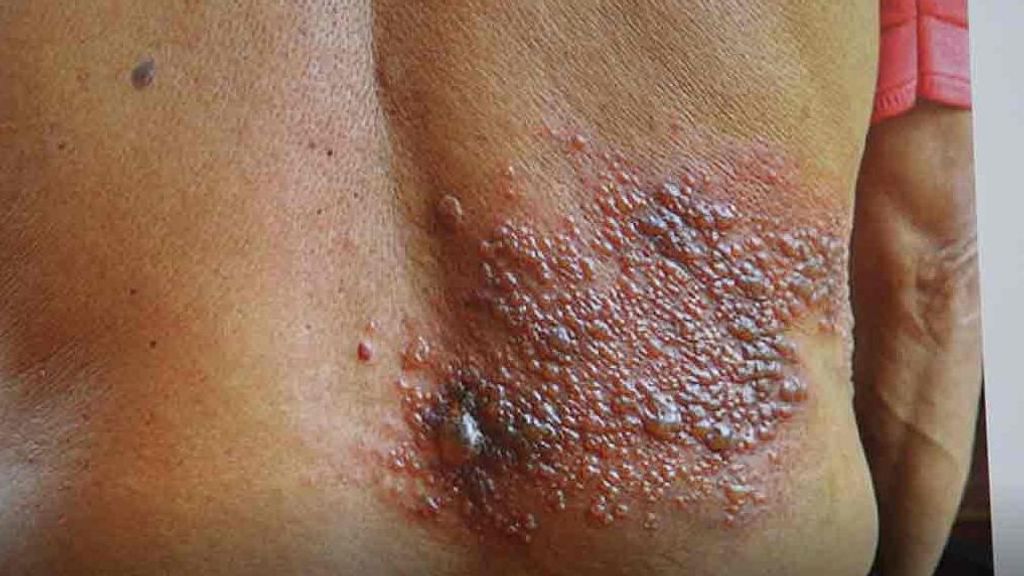 Síntomas y tratamiento para el herpes zóster