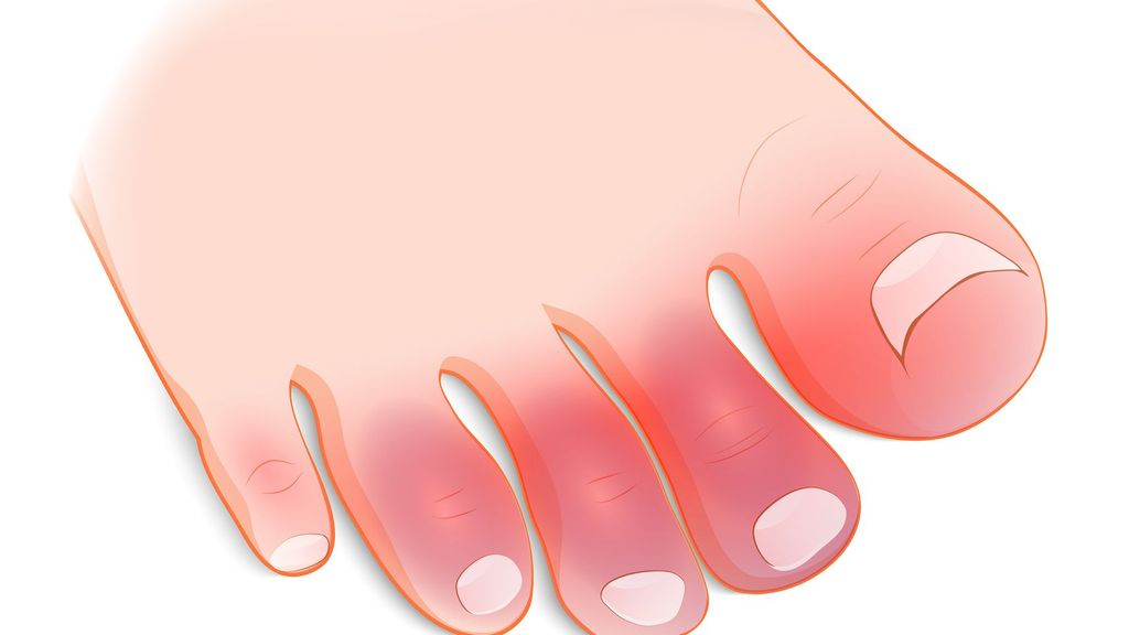 Los sabañones o perniosis pueden favorecer la sensación de pies fríos