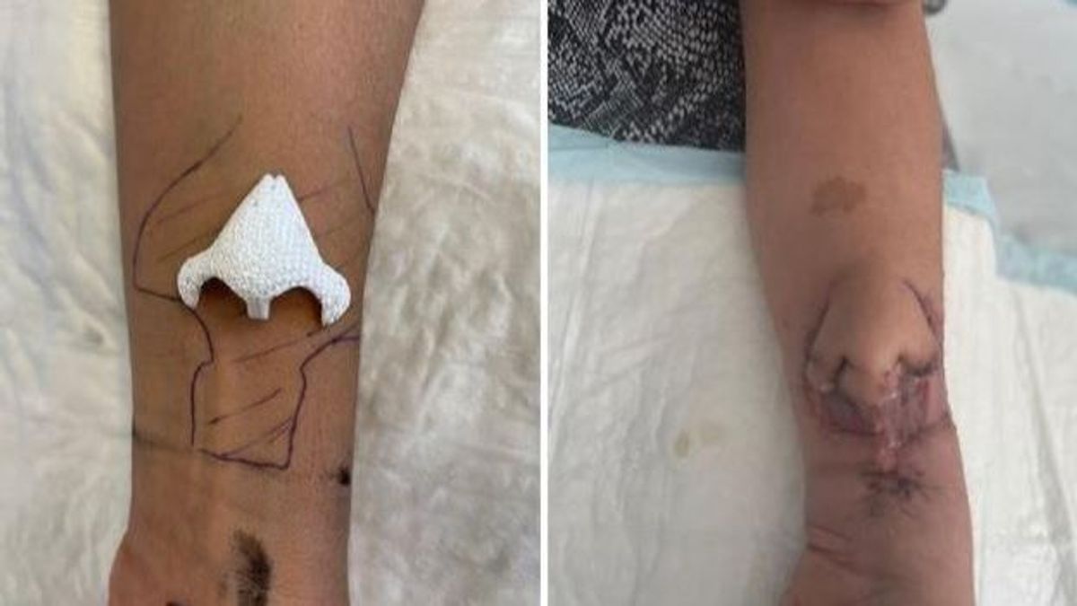 Médicos franceses consiguen crear en el brazo de una mujer una nariz artificial