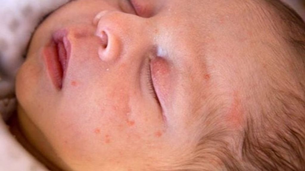 El acné neonatal aparee en esas primeras semanas de vida del bebé.