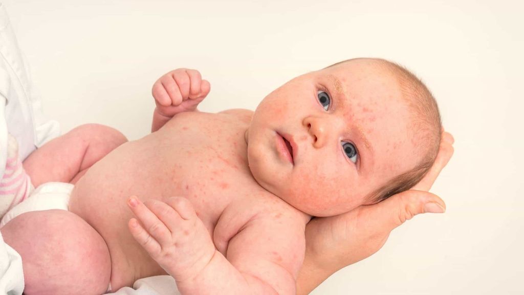 Qué es el acné neonatal y cómo tratarlo.