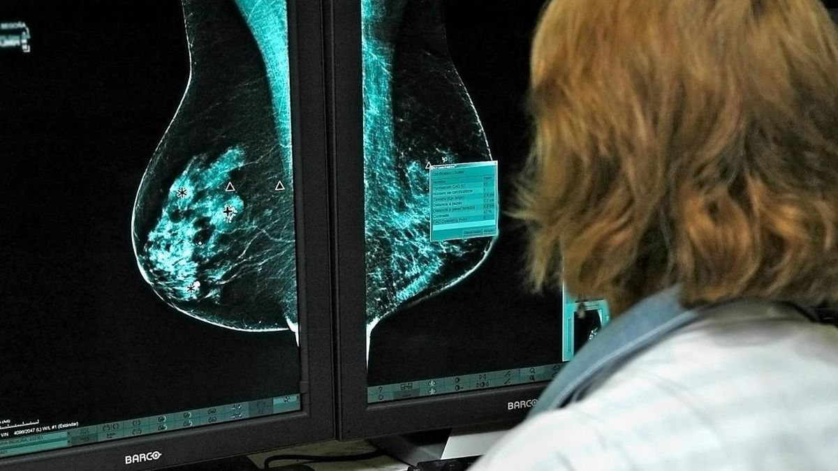 Cáncer de mama Cáncer de mama