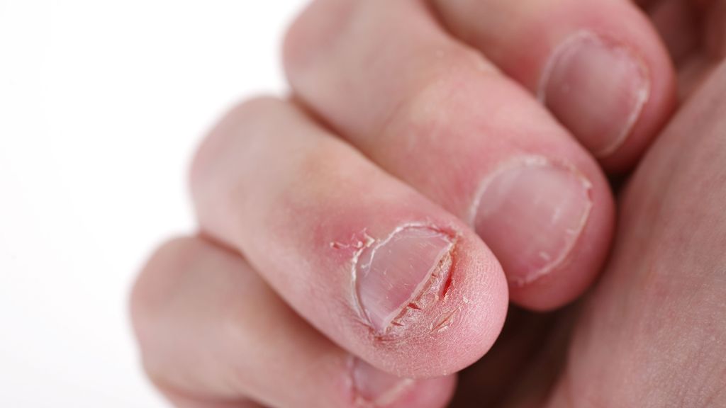 Consecuencias para la salud de morderse las uñas