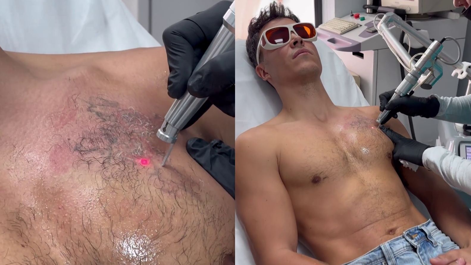 Kiko Jiménez se borra los tatuajes