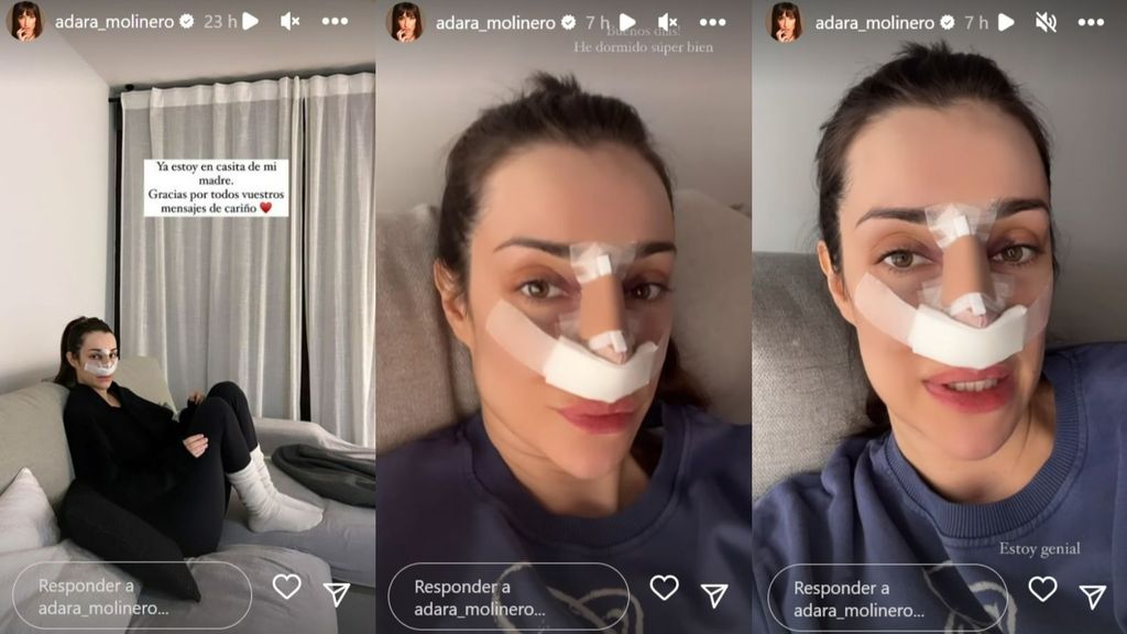 Adara Molinero habla de su rinoplastia