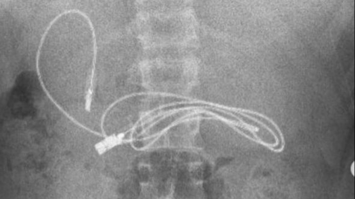 Descubren un cable USB en el estómago de un adolescente