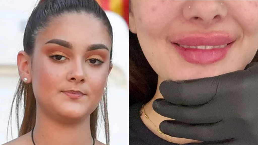El antes y el después de Julia Janeiro tras su retoque en los labios
