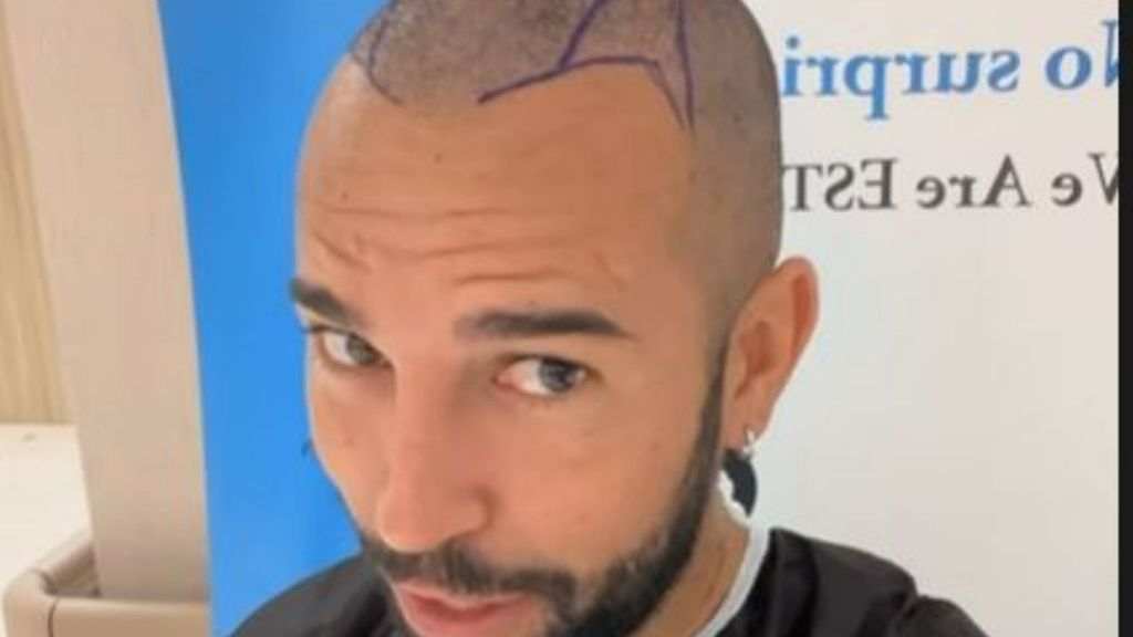 Omar Sánchez se somete a un trasplante de cabello en Turquía