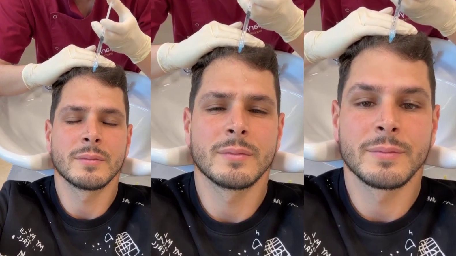 alejandro nieto mesoterapia capilar