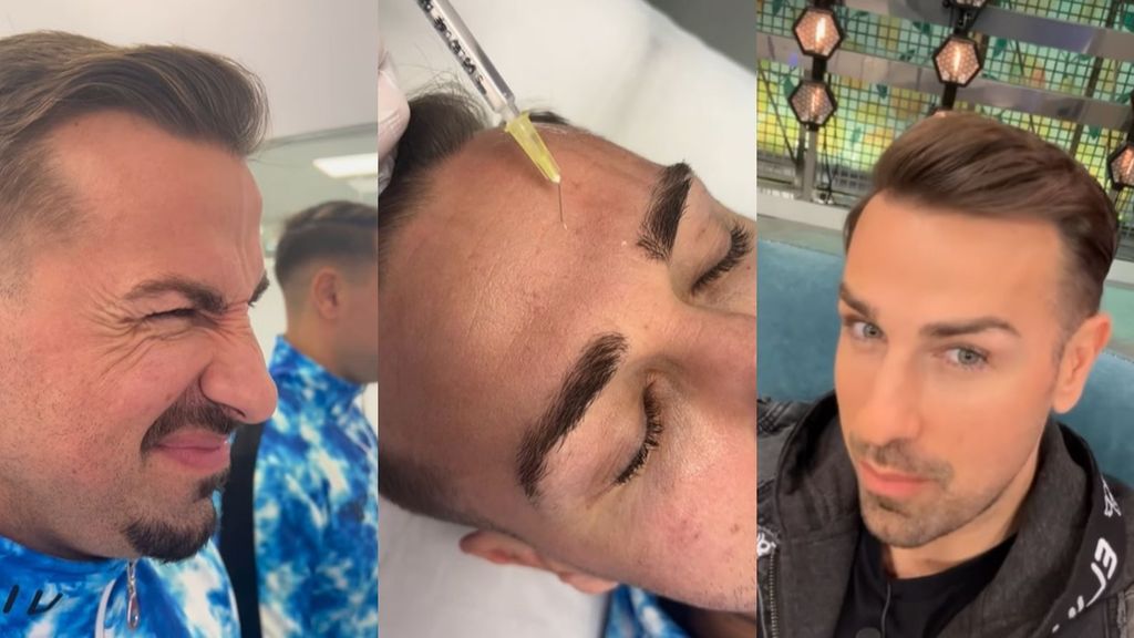 Rafa Mora muestra el antes y el después de su último retoque estético