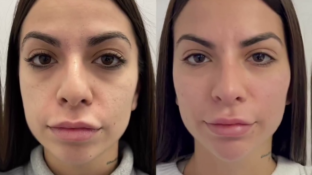 El sorprendente antes y después de Ana Nicolás tras someterse a varios retoques estéticos