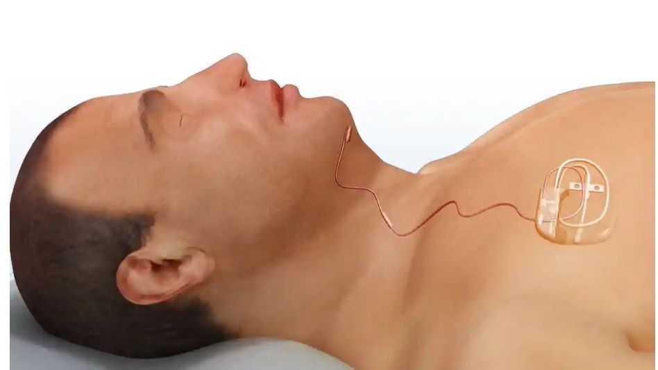 British scientists develop an implant to treat obstructive sleep apnea