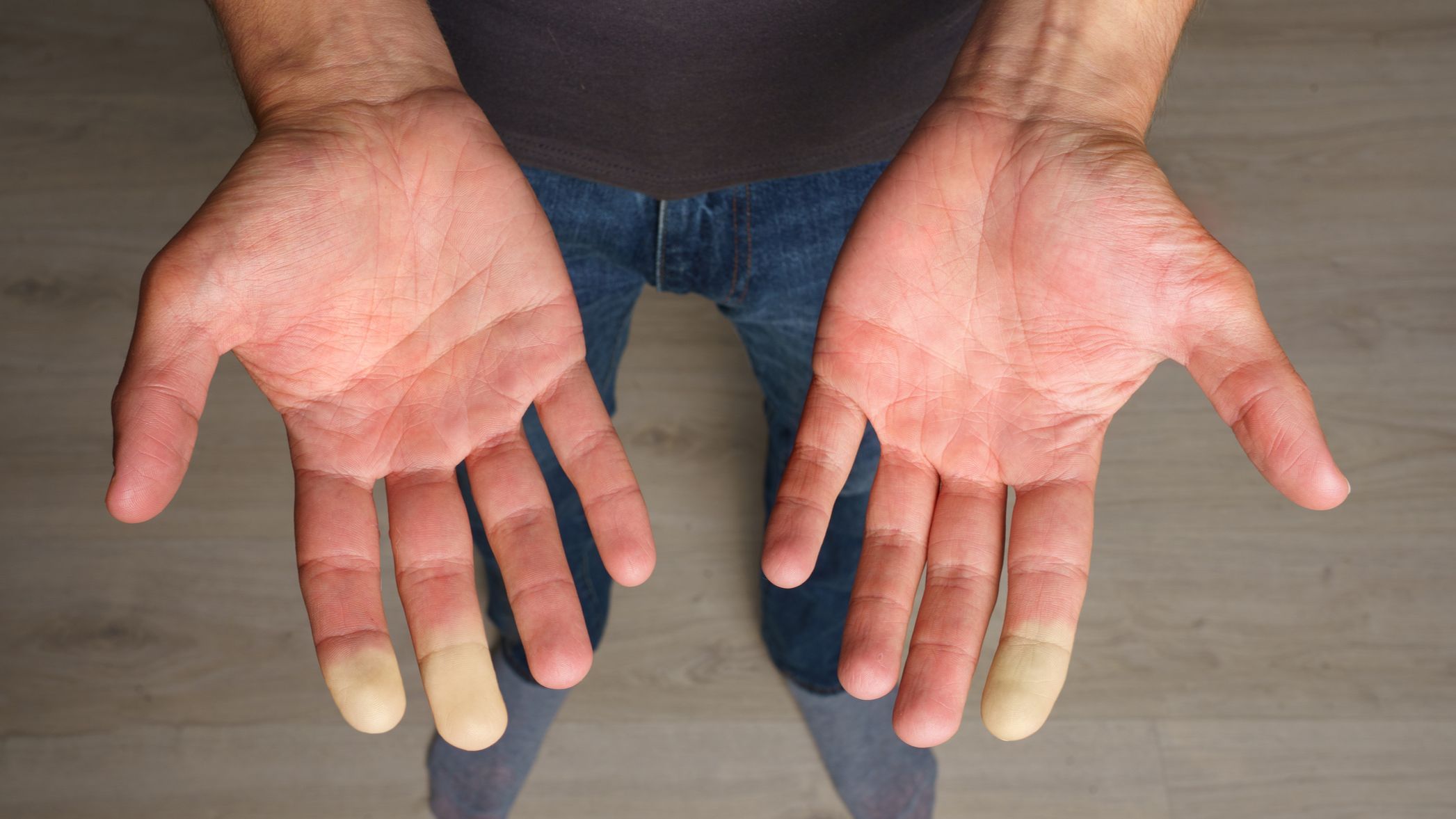 Enfermedad de Raynaud