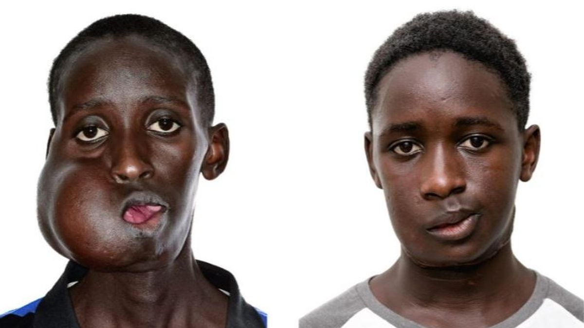 Extirpan una tumoración facial de más de 20 centímetros a un adolescente senegalés que no podía casi comer ni beber