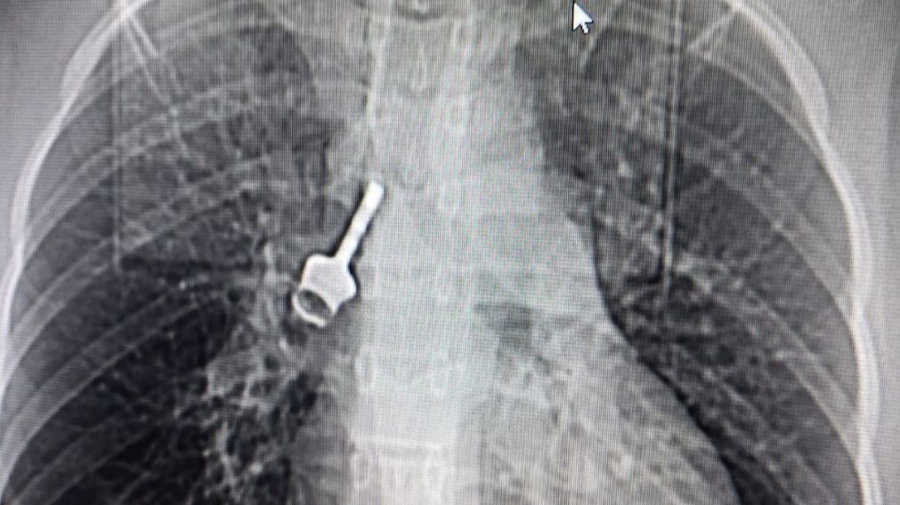 La llave en el pulmón de la niña.