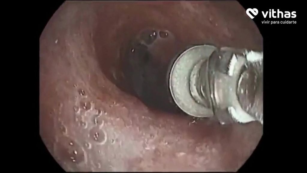 Extraen un tornillo del pulmon de una mujer de 70 años de Vigo