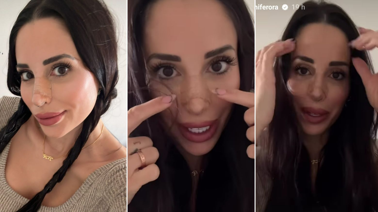 Jennifer Ortiz se somete a una rinoplastia secundaria: su antes y después
