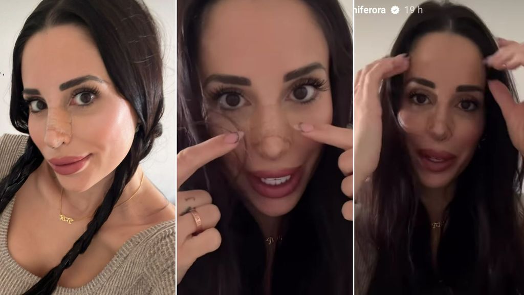 Jennifer Ortiz se somete a una rinoplastia secundaria: su antes y después