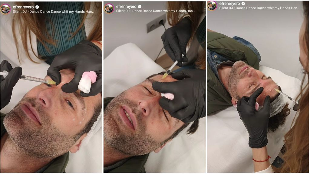 Efrén Reyero ha pasado por varias sesiones de Skinbooster