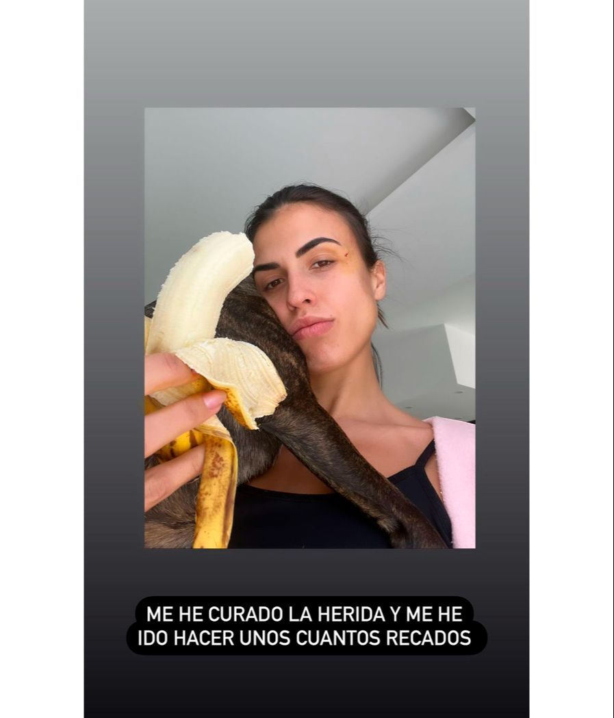 Sofía Suescun ha mostrado cómo ha quedado la zona afectada de su herida tras cortar la sangre