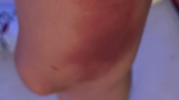 Lidia Torrent enseña sus quemaduras tras volcarse una olla de agua hirviendo