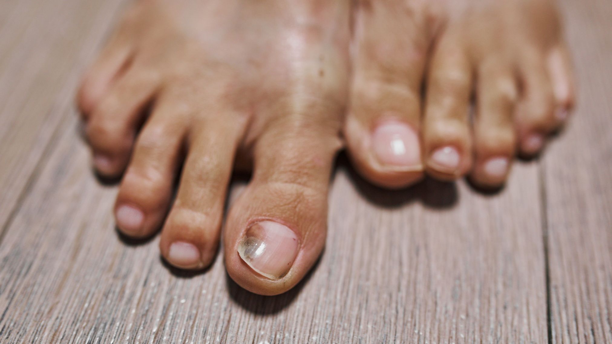 Enfermedades de las uñas más comunes