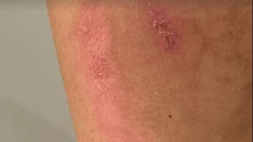 La evolución de las quemaduras de Lidia Torrent