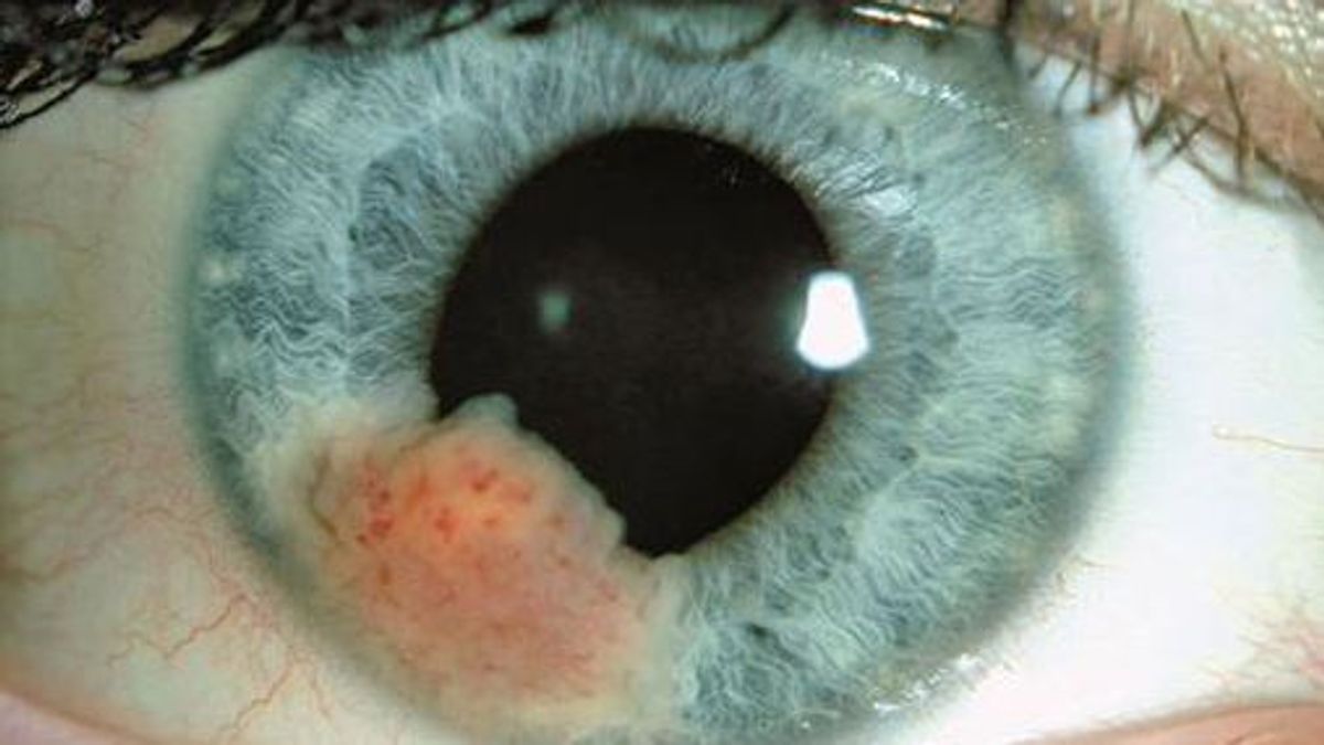 Cáncer de ojo, el más frecuente es el melanoma ocular