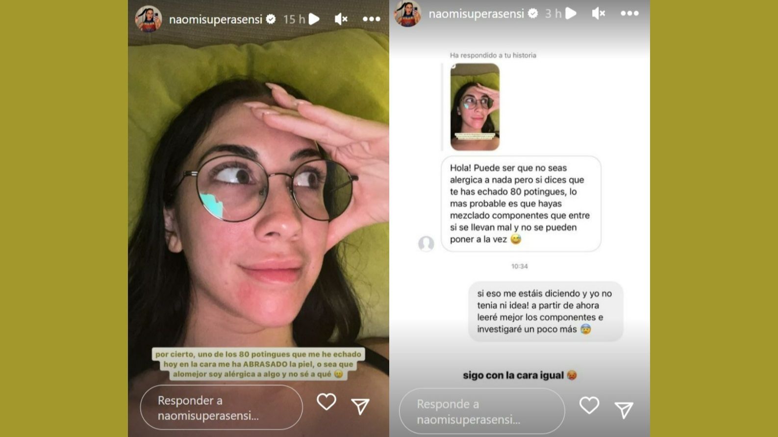 Naomi Asensi muestra su "piel abrasada"