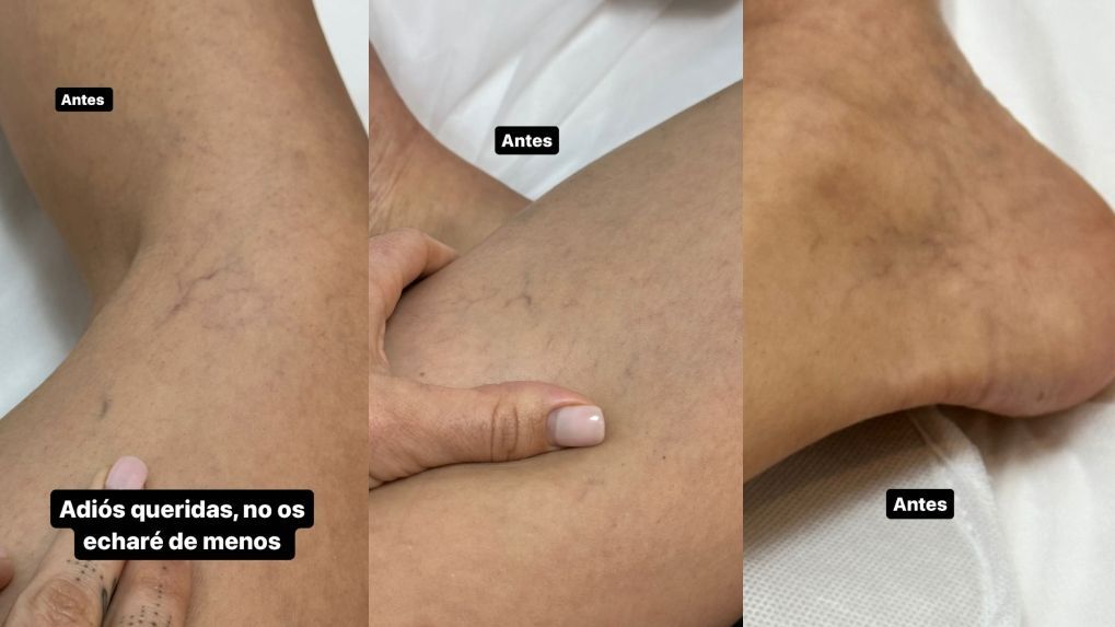 El aspecto de las piernas y tobillos de Violeta antes de eliminar sus arañas vasculares
