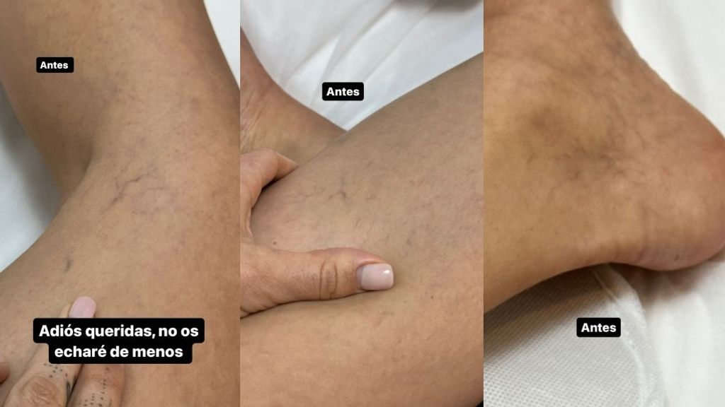 El aspecto de las piernas y tobillos de Violeta antes de eliminar sus arañas vasculares