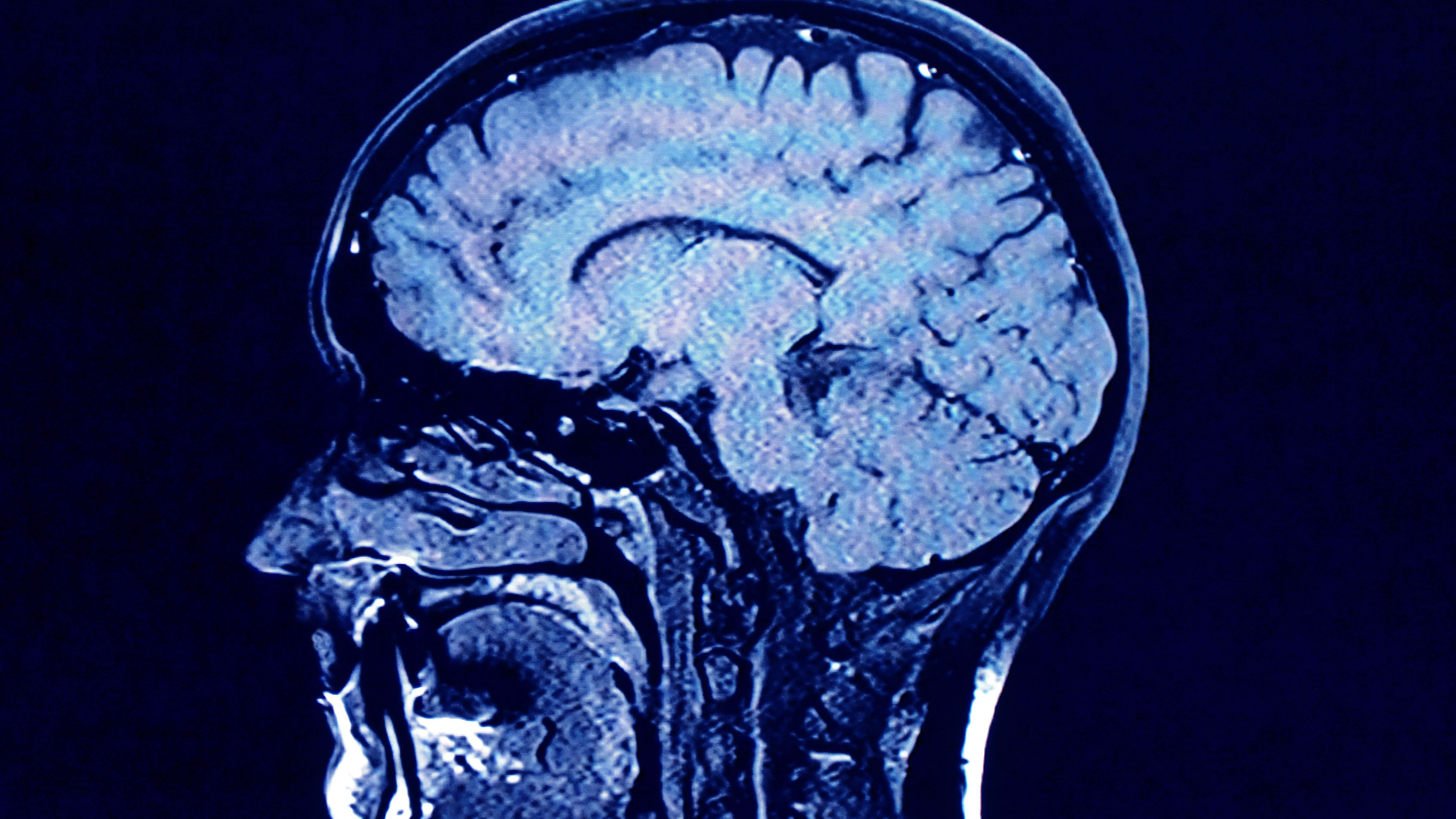 El lecanemab es uno de los últimos fármacos en la lucha contra el alzhéimer