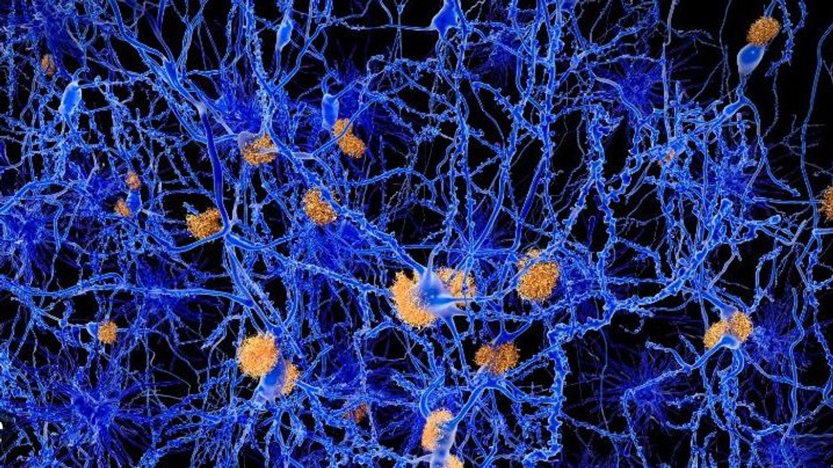 Un prometedor fármaco para tratar el alzhéimer encoge el cerebro