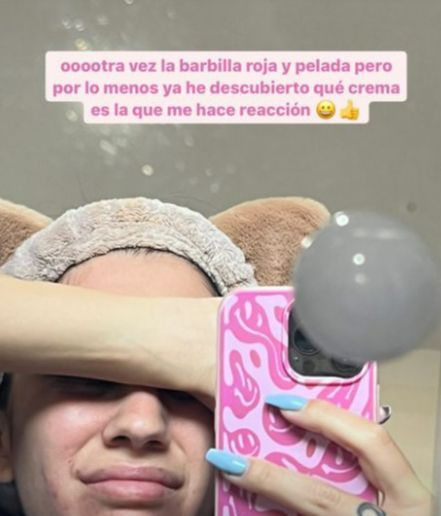 Naomi Asensi se vuelve a quemar la piel y cree haber encontrado la causa