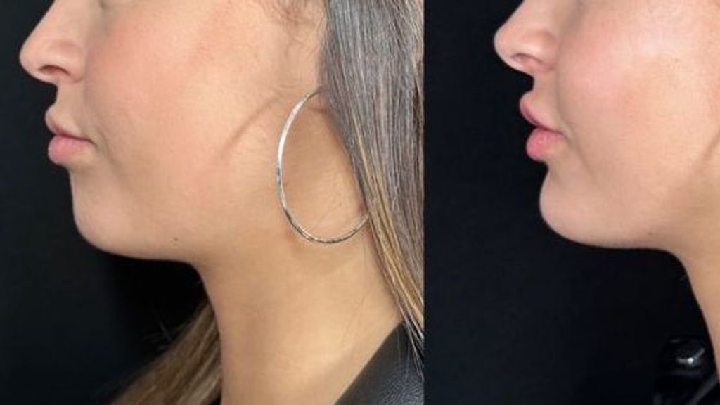 El antes y el después de Tania Déniz tras varios retoques estéticos en el rostro