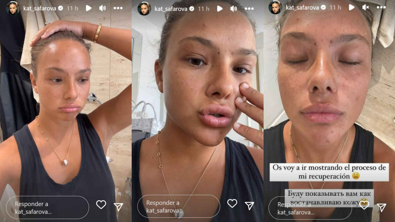 Katerina, preocupada por la sequedad de su piel