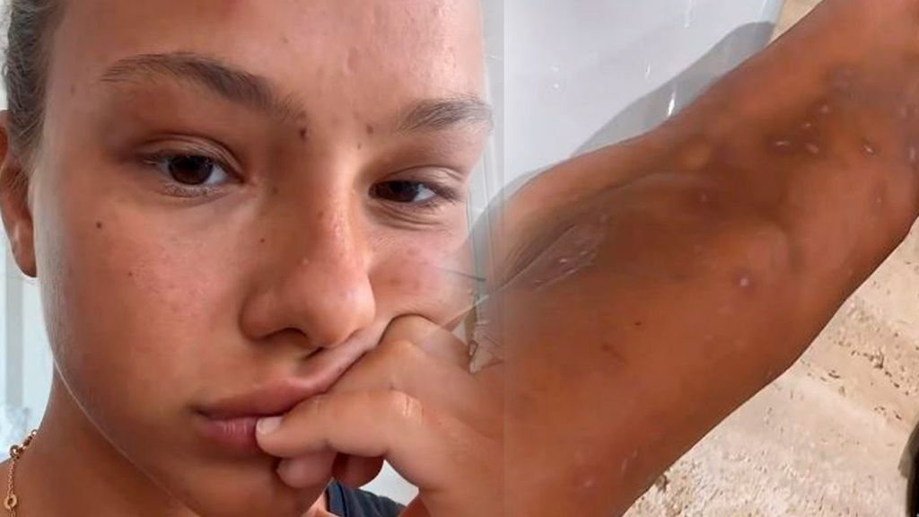 Katerina Safarova enseña los estragos de su piel tras 'Supervivientes'