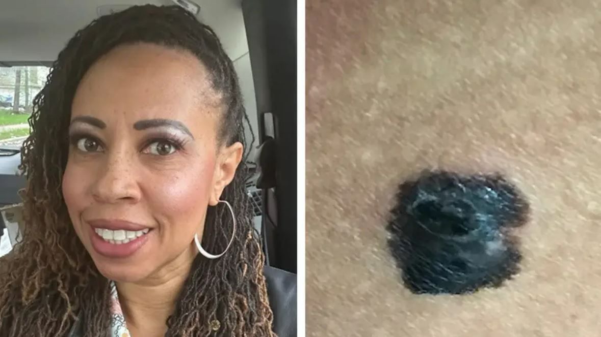 Ilia J. Smith y su mancha de nacimiento que acabó siendo un melanoma