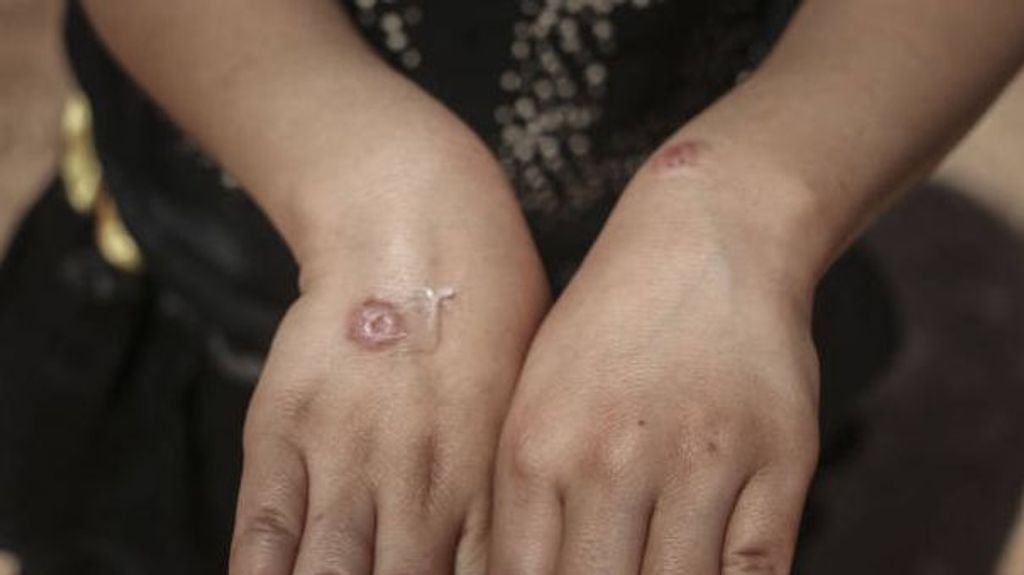 Leishmaniasis: ¿qué es, cómo se contagia y cuál es el tratamiento a seguir?