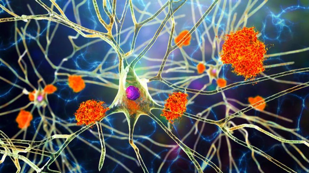 Averiguan cómo se extienden las proteínas tóxicas en el Alzheimer: "Podríamos detener la enfermedad"