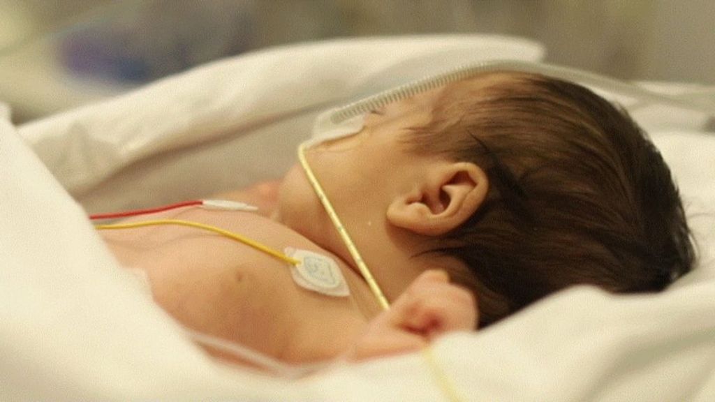 Un bebé de un solo 12 horas salva la vida gracias a la máquina ECMO