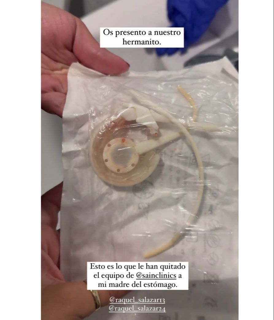 Noemí Salazar enseña la banda gástrica que tenía su madre en el estómago