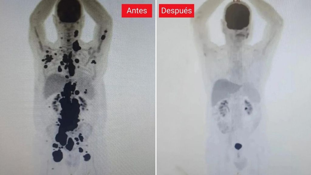 Antes y después de un paciente con cáncer