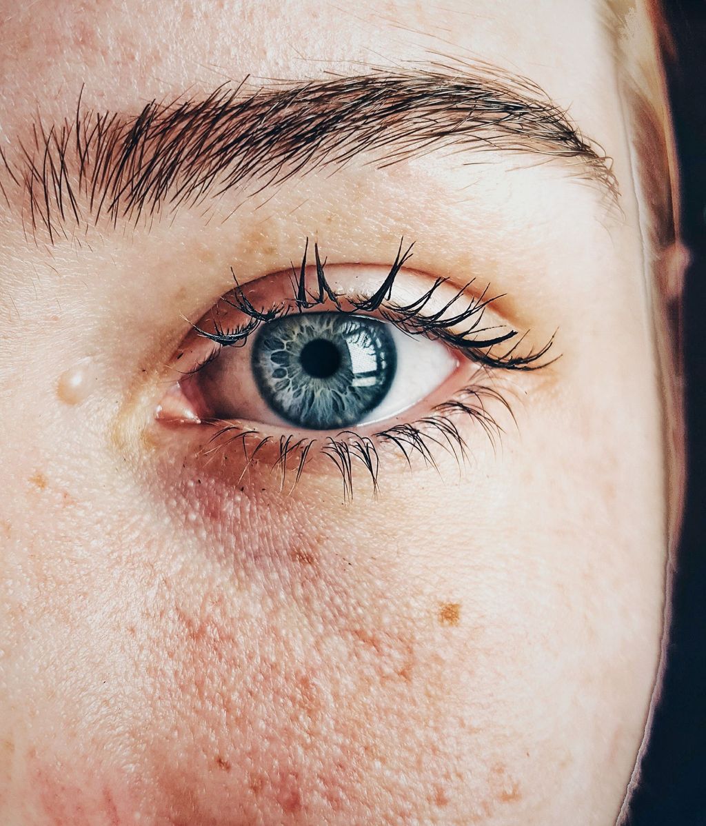 A veces afecta al ojo. FUENTE: Pexels