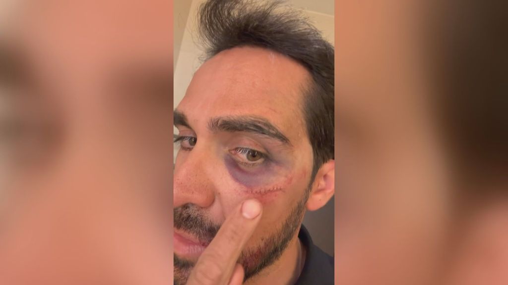 Alberto Contador comparte las imágenes de su dura caída en China: “Había muchísima sangre”