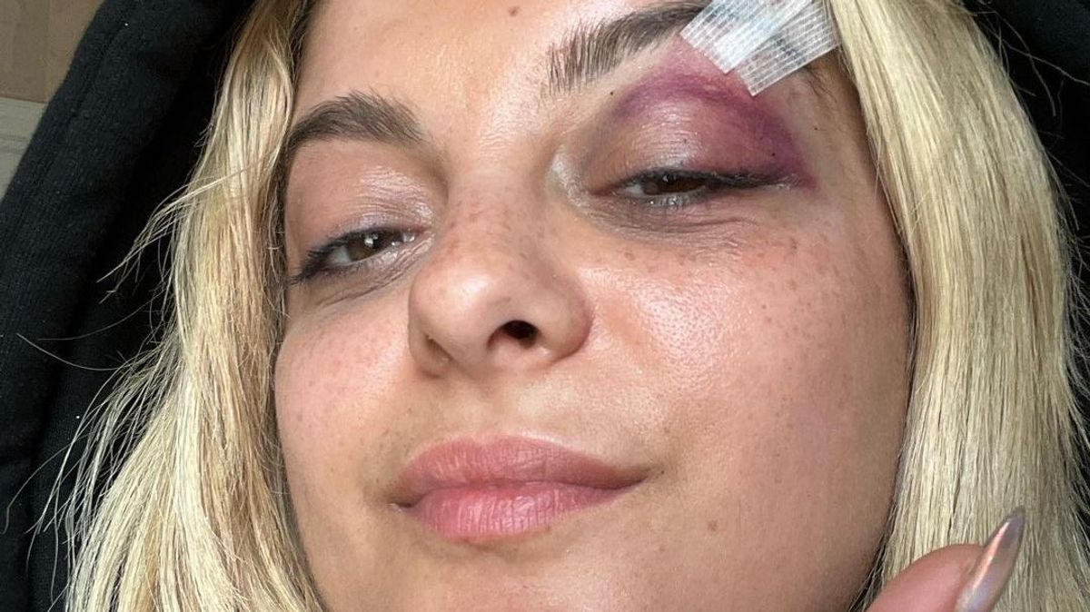 Bebe Rexha, golpeada por un teléfono en la cabeza en pleno concierto en Nueva York, muestra sus secuelas