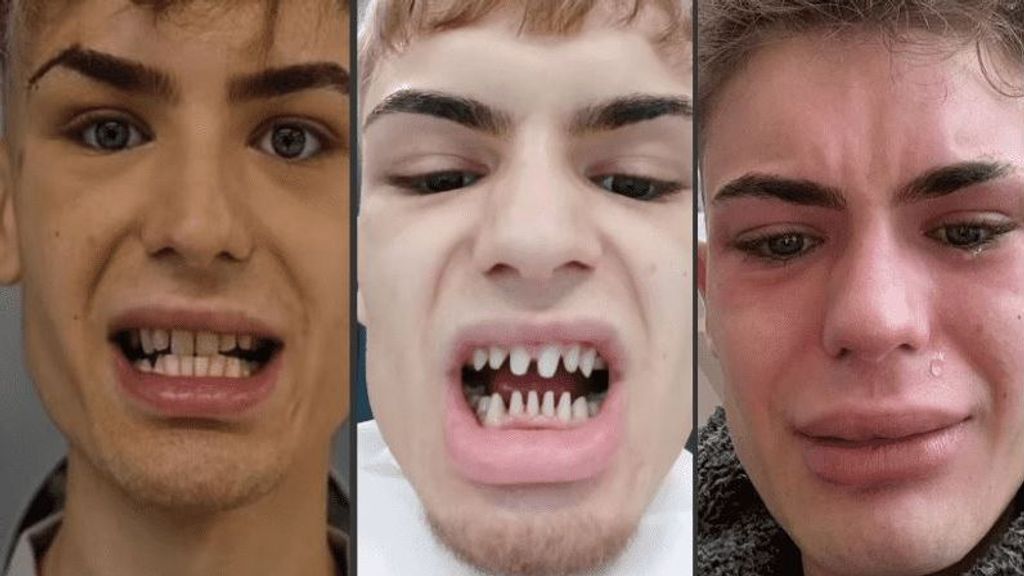 Jack James viajó a Estambul para un diseño de sonrisa y le destrozaron los dientes