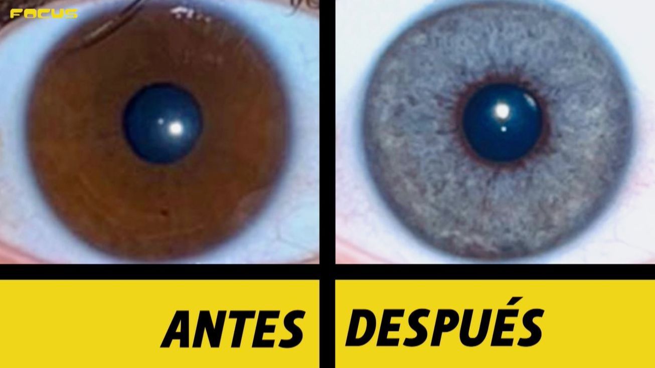 La despigmentación, la intervención en auge para cambiar el color de los ojos
