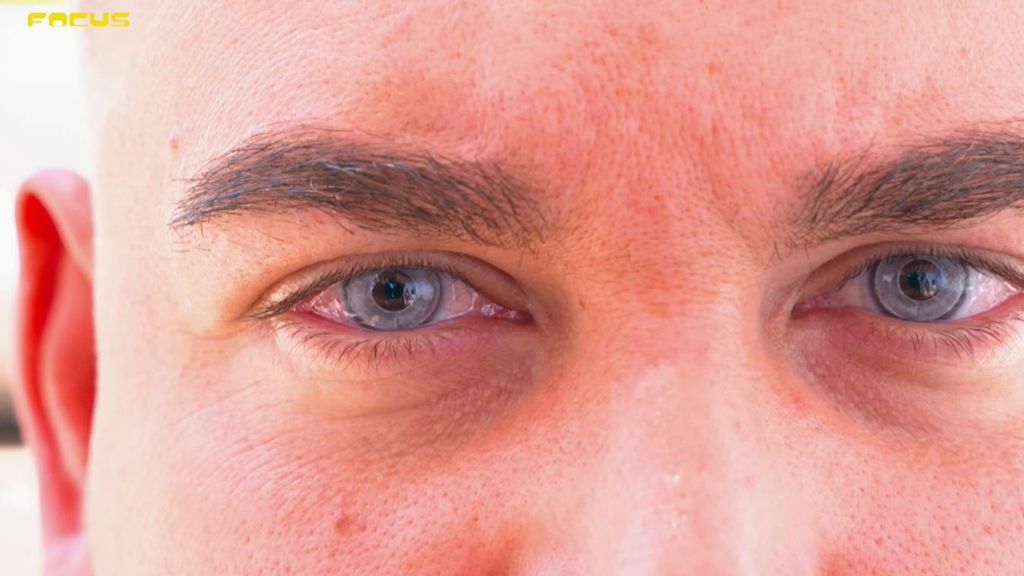 Cambiar el color de los ojos es posible con la queratopigmentación