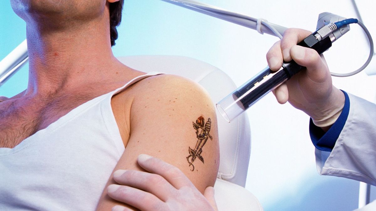 Quitar tatuajes también tiene sus peligros